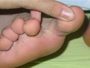 kāju pirkstu sēnītes simptomi