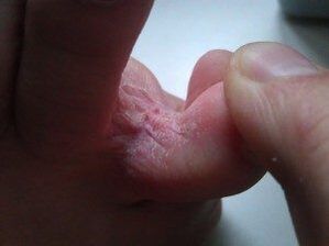 ādas bojājumi starp kāju pirkstiem ar sēnīti