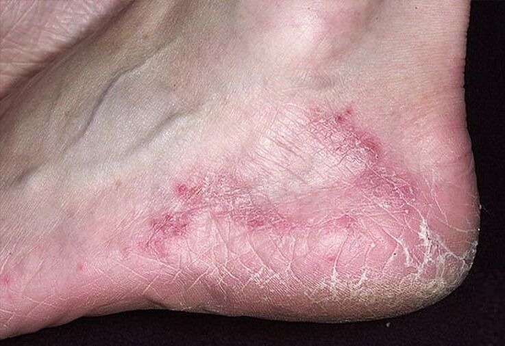 Papēžu ādas plaisas un apsārtums ir sēnīšu infekcijas pazīmes