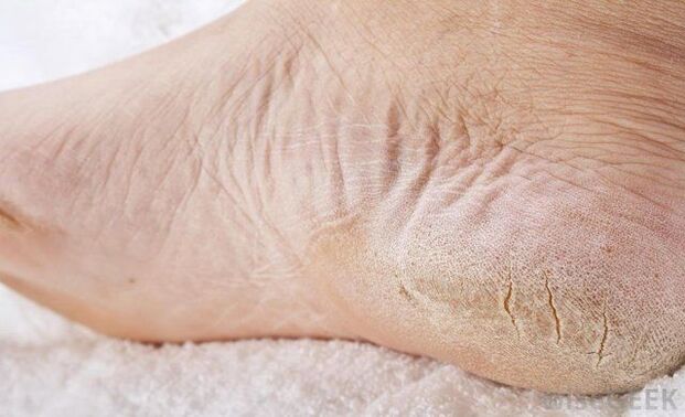 sausas kājas ir sēnītes pazīme