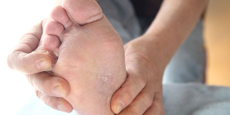 ādas bojājumi ar sēnīti uz kājām